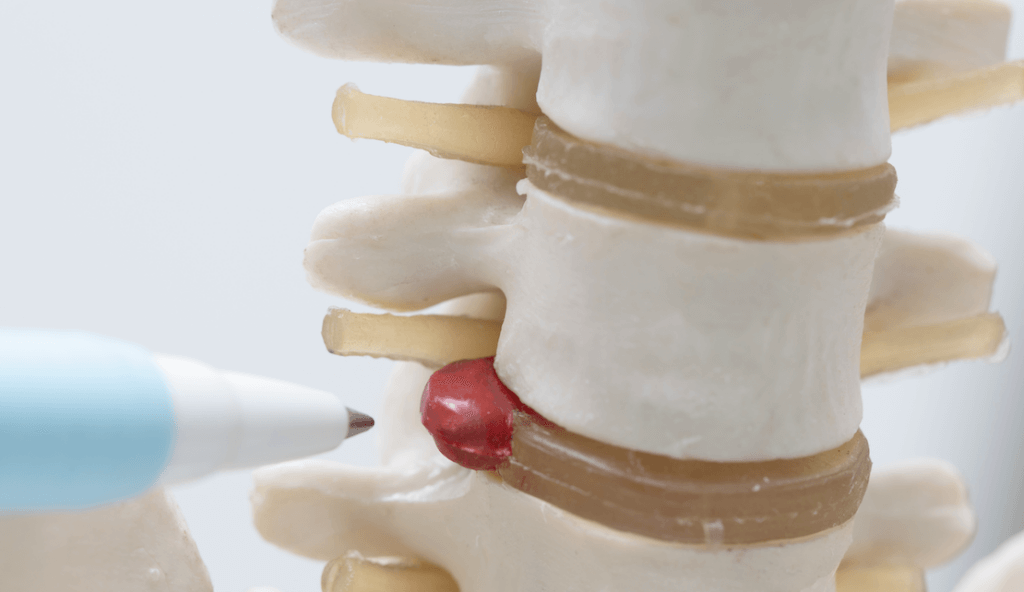 3 signs you are suffering from a herniated disc or bulging disc